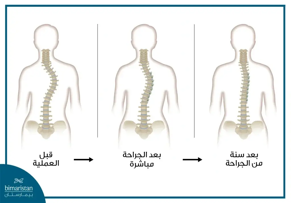 تكلفة علاج الجنف في تركيا 2025: جودة ممتازة بأسعار تنافسية 2 صورة توضح نتائج عملية علاج الجنف