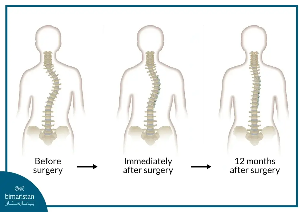 Scoliosis Treatment Cost In Turkey 2025: Top Quality Care 2 Image Showing The Results Of Scoliosis Surgery And How They Relate To Scoliosis Treatment Cost.