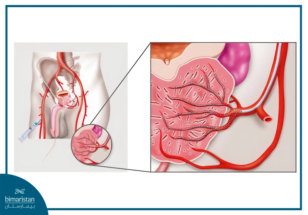 Prostate Cancer Embolization Cost In Turkey: An Image Showing How The Procedure Is Done