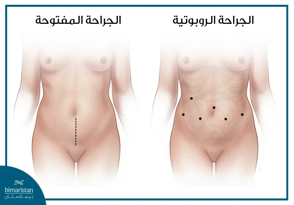 تكلفة عملية استئصال المثانة في تركيا 2025: بين الخبرة الطبية والتكلفة المناسبة 2 تكلفة عملية استئصال المثانة في تركيا: طرق التدخل الجراحي