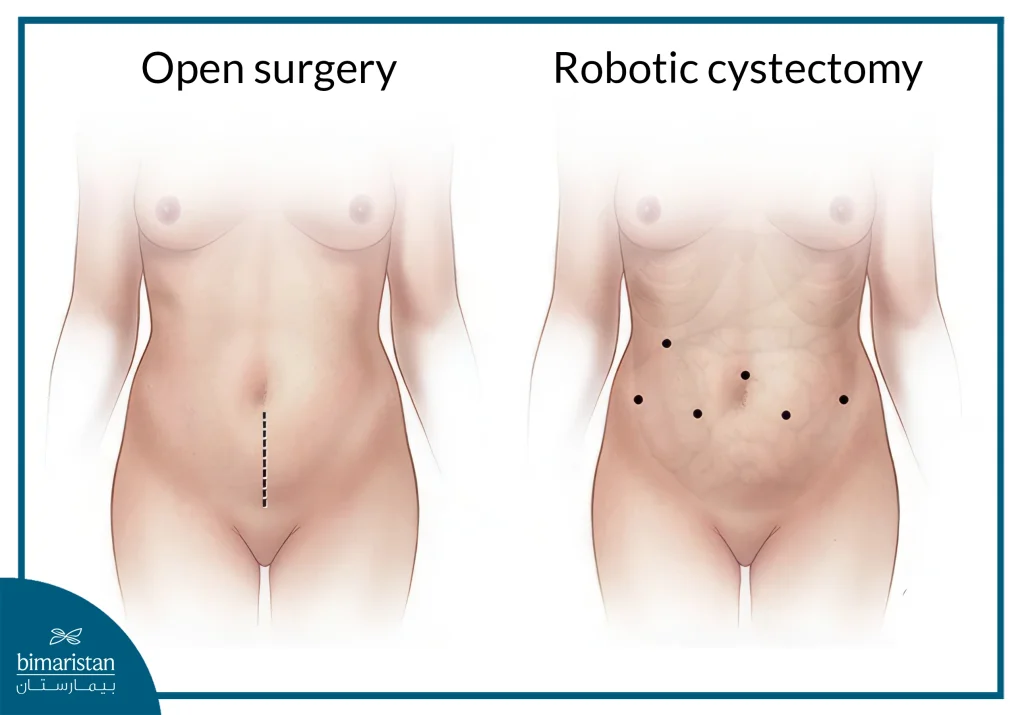 Bladder Cystectomy Cost In Turkey 2025: A Balance Of Affordability And Expert Care 2 Bladder Cystectomy Cost In Turkey