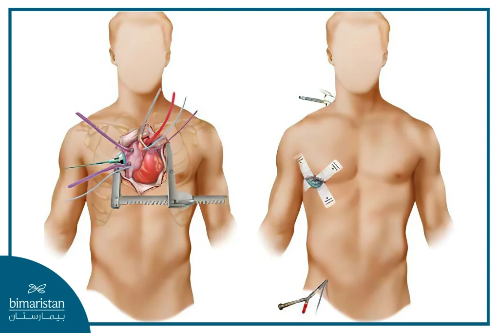 Open Heart Surgery Cost In Turkey Explained: Best Value For Top-Quality Treatment 2 An Image Showing The Difference Between Traditional Open Heart Surgery And Minimally Invasive Closed-Heart Surgery