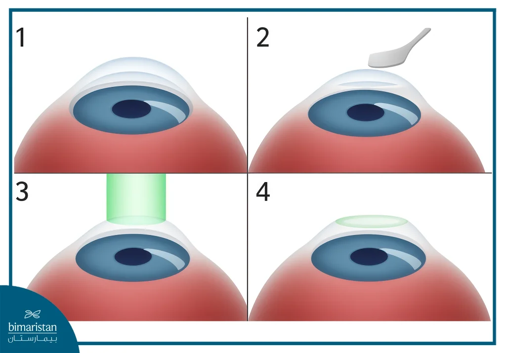 Laser Surgery Cost In Turkey: Safe, Trusted Treatment Guide 2 Photos Showing The Steps Of The Laser Surgery Process In Order To Understand What Affects The Laser Surgery Cost.