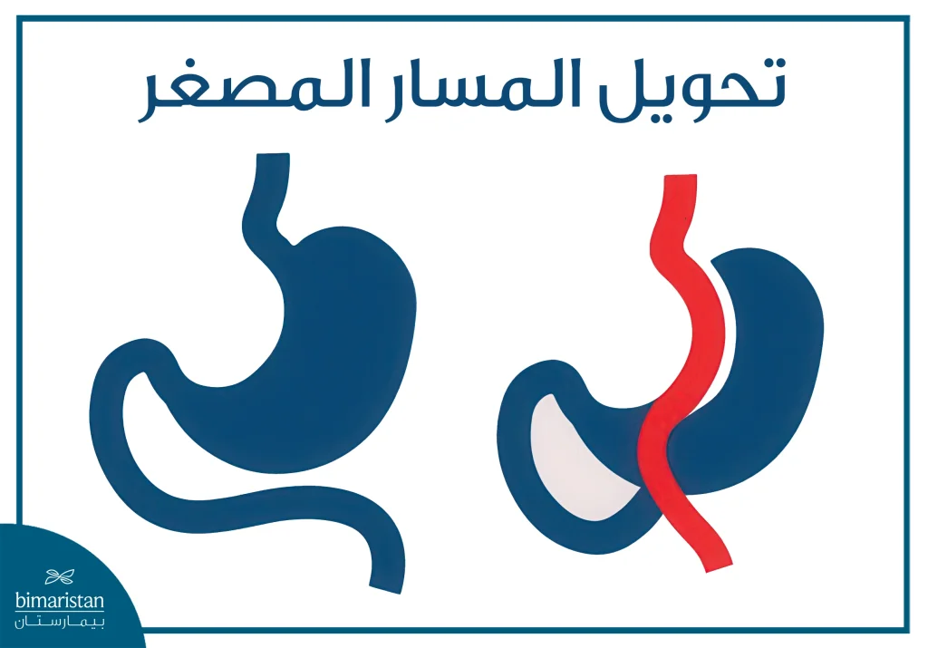 تكلفة عملية تحويل المسار المصغر في تركيا: الدليل الشامل 2025 2 تكلفة عملية تحويل المسار المصغر في تركيا: صورة تُظهر كيف تتم العملية