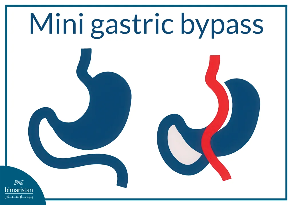Mini Gastric Bypass Cost In Turkey: An Image Showing How The Procedure Is Done
