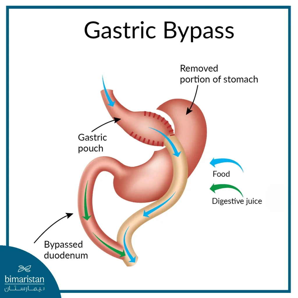 Gastric Bypass Cost In Turkey: Full 2025 Guide To Prices &Amp; Packages 2 Gastric Bypass Surgery Cost In Türkiye: A Picture Showing How The Procedure Is Performed.