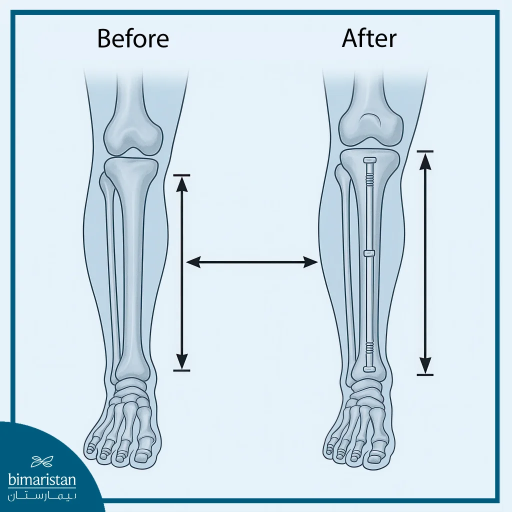 Limb Lengthening Cost In Turkey 2025: Affordable Surgery For A Taller You 2 Bone Lengthening Surgery: Before And After