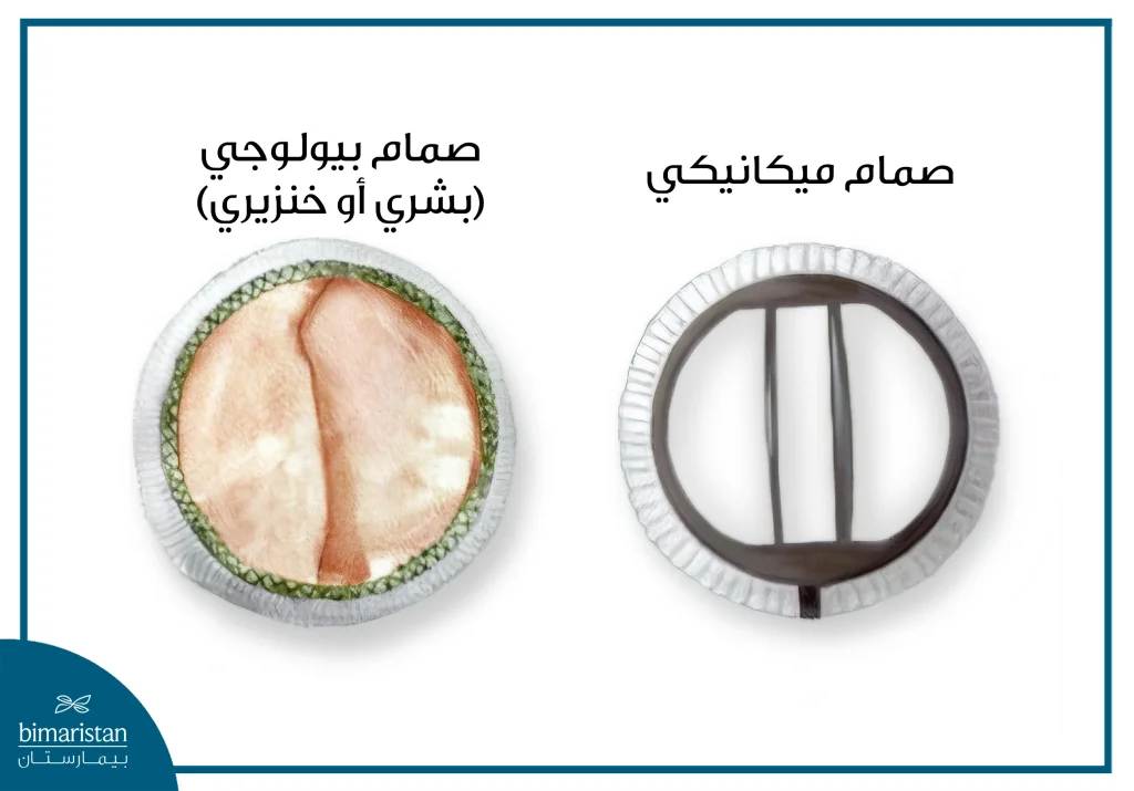 صورة توضح شكل أنواع الصمامات المستخدمة في عملية تغيير صمامات القلب