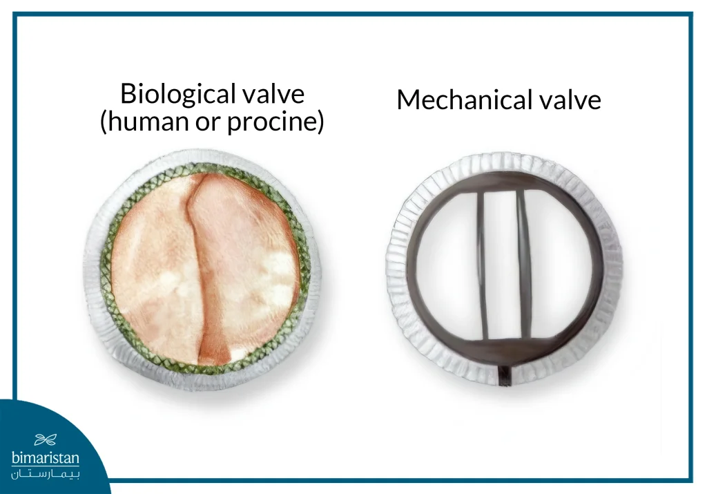 Heart Valve Replacement Cost In Turkey: Exceptional Care At Competitive Prices 2 An Image Showing What The Types Of Valves Used In Heart Valve Replacement Surgery Look Like—Important For Understanding Heart Valve Replacement Cost In Turkey.