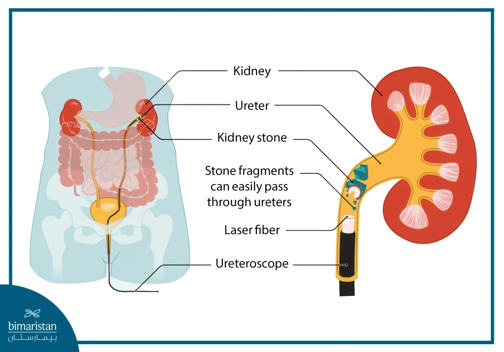 Laser Lithotripsy Cost In Turkey: Everything You Need To Know 2 Laser Lithotripsy Treats Kidney Stones Effectively With A Low Laser Lithotripsy Cost.