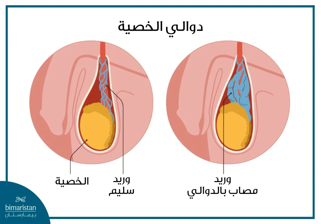 صورة توضيحية لدوالي الخصية