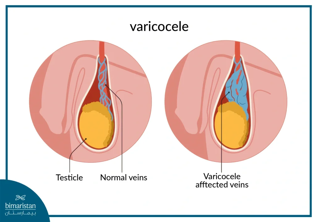 Varicocele Surgery Cost In Turkey: A Comprehensive Guide 2 Illustration Of A Varicocele Helps Patients Understand The Condition And The Factors Influencing The Varicocele Surgery Cost.