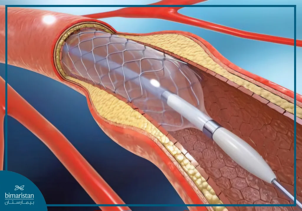 Cardiac Catheterization Cost In Turkey: What To Expect For Safe, Affordable Care 2 A Form Of Therapeutic Catheterization To Widen The Arteries