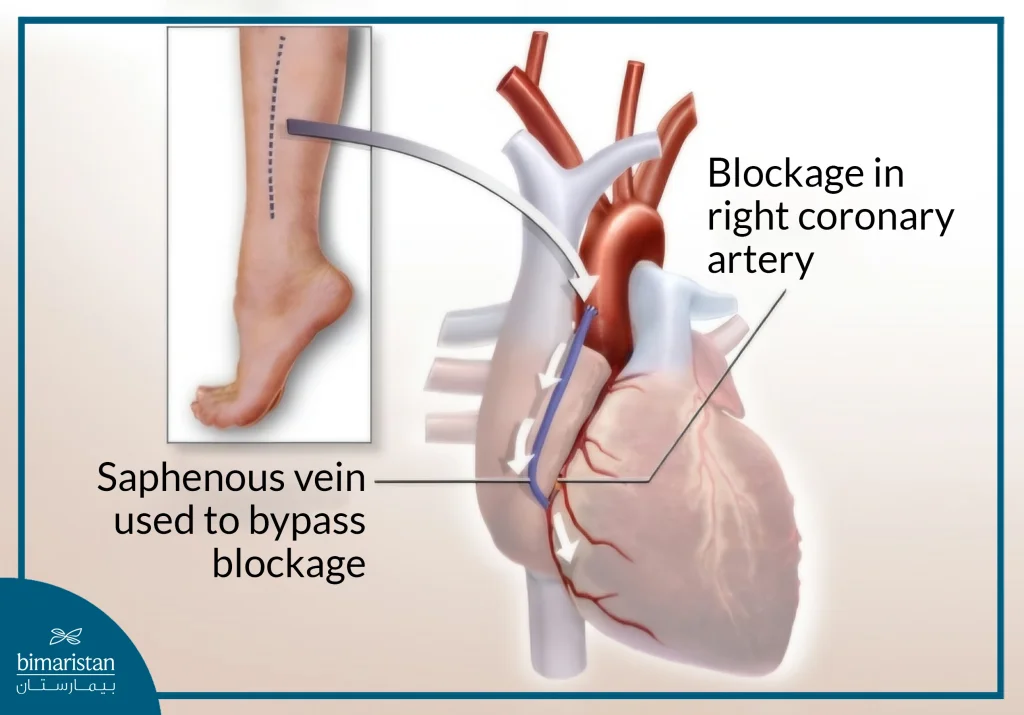 Coronary Artery Bypass Grafting Cost In Turkey: Affordable Options And World-Class Care 2 An Image Showing The Use Of A Saphenous Vein To Bypass A Blockage In The Right Coronary Artery And Restore Blood Flow To The Heart