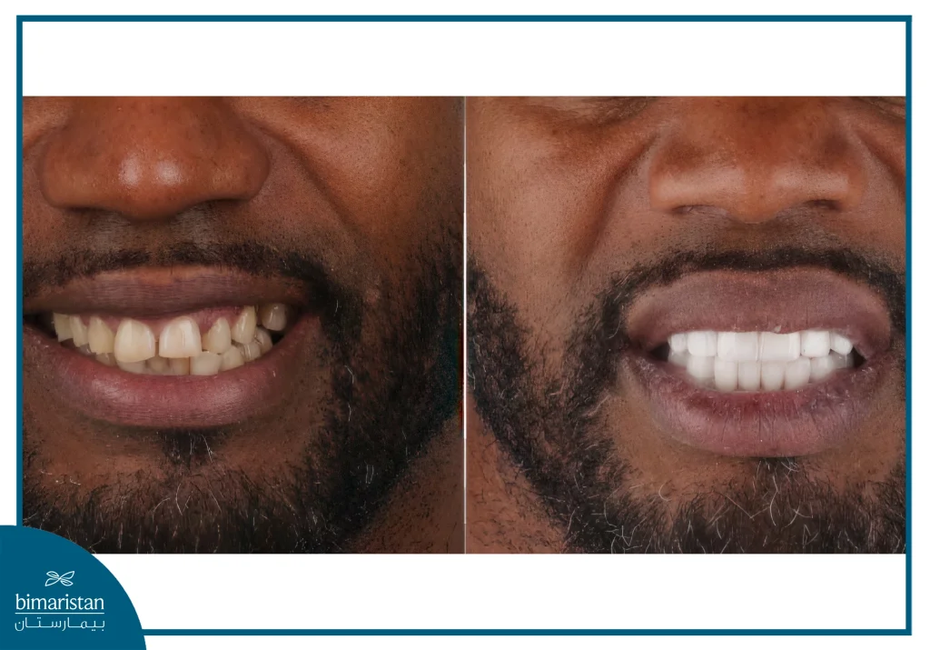 Hollywood Smile Cost In Turkey 2025: Your Vip Ticket To A Stunning Smile 2 The Difference Between A Person'S Teeth Before And After A Hollywood Smile