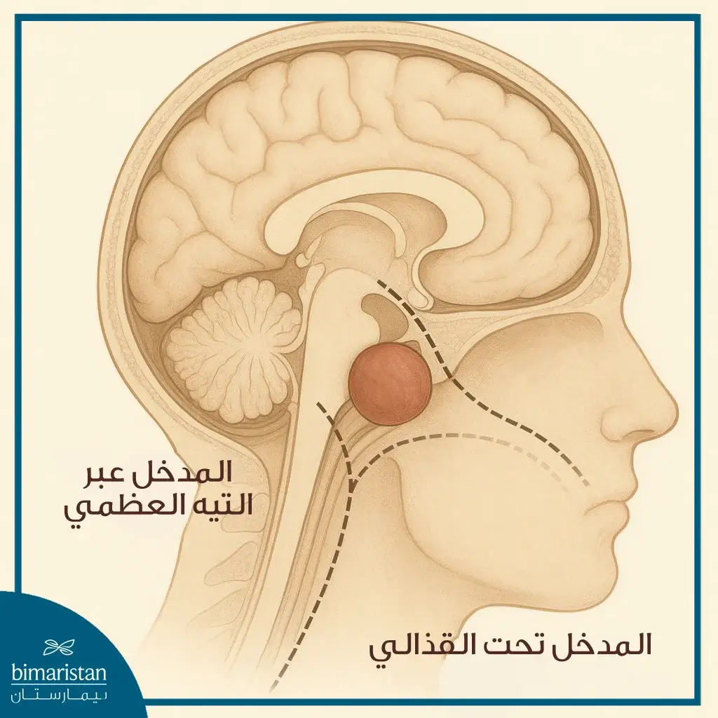 صورة توضح المسار تحت القذالي و مسار العظم الصدغي الذي يتابع طريقه عبر التيه العظمي في جراحة أورام الزاوية