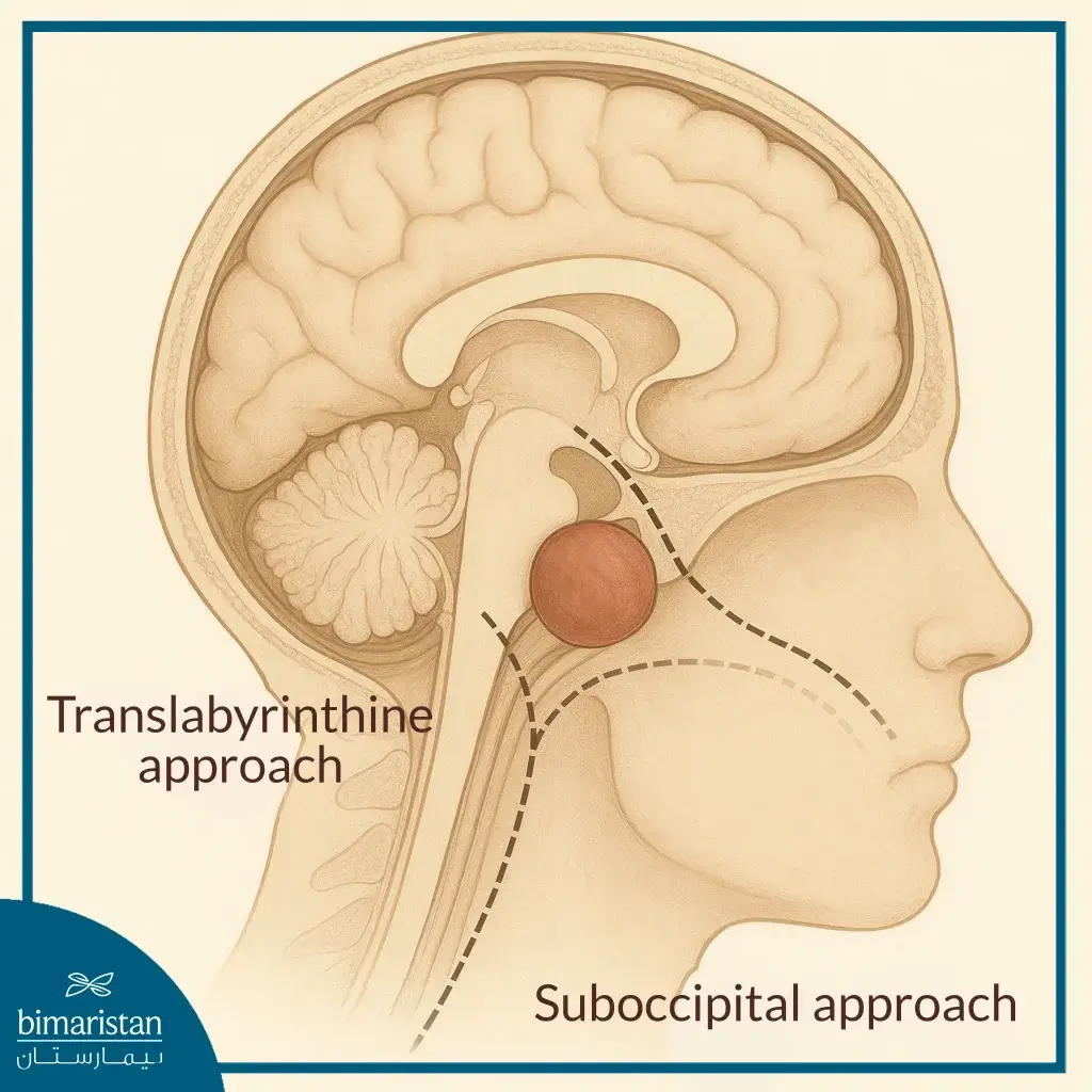 Cerebellopontine Angle Tumor Surgery: When &Amp; Why? 3 Image Showing The Suboccipital And Temporal Bone Pathway That Continues Through The Bony Labyrinth In Cerebellopontine Angle Tumor Surgery