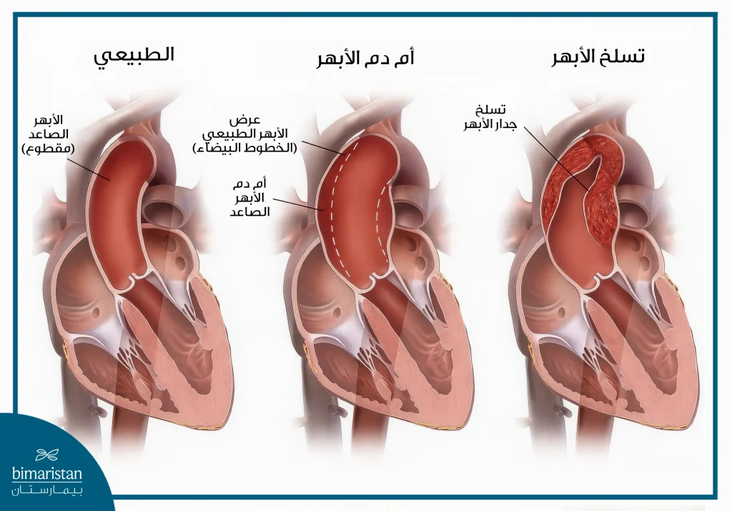 جراحة الشريان الأبهر: الدليل الشامل من التشخيص إلى التعافي الكامل 3 صورة توضح الفرق بين الشريان الأبهر الطبيعي وتمدد الأبهر (أم الدم) وتسلخ الأبهر