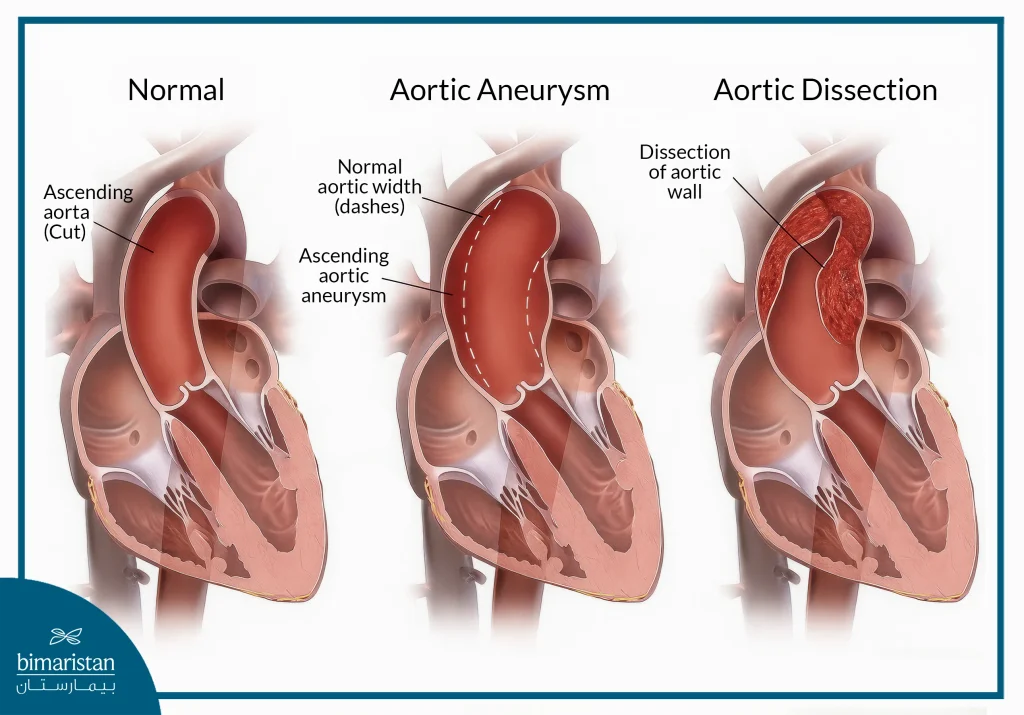 Aortic Surgery: Complete Guide From Diagnosis To Full Recovery 3 Image Showing The Difference Between A Normal Aorta And Conditions That May Require Aortic Surgery, Such As An Aortic Aneurysm And Aortic Dissection.