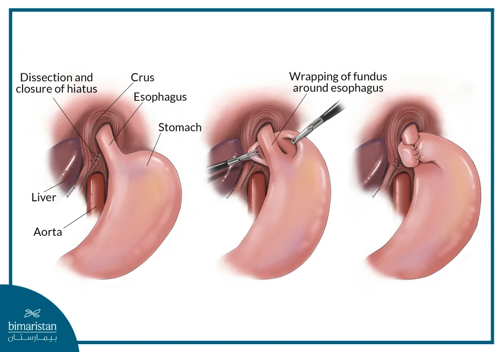 Esophageal Surgery: Indications, Procedure, And Success Rates 3 Schematic Image Showing The Wrapping Of The Gastric Fundus Around The Lower Esophagus In The Nissen Procedure, A Common Form Of Esophageal Surgery.
