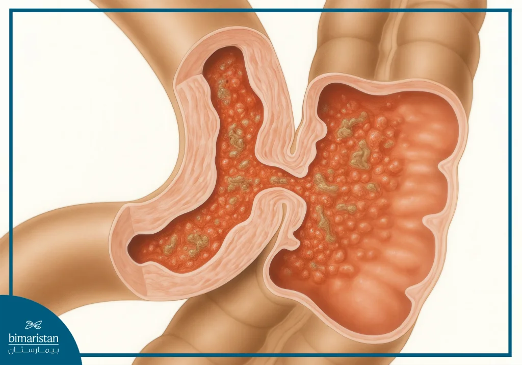 Intestinal Fistula Surgery: Indications, Procedure Steps, And Recovery Explained 3 Image Showing What An Intestinal Fistula Looks Like During Intestinal Fistula Surgery.