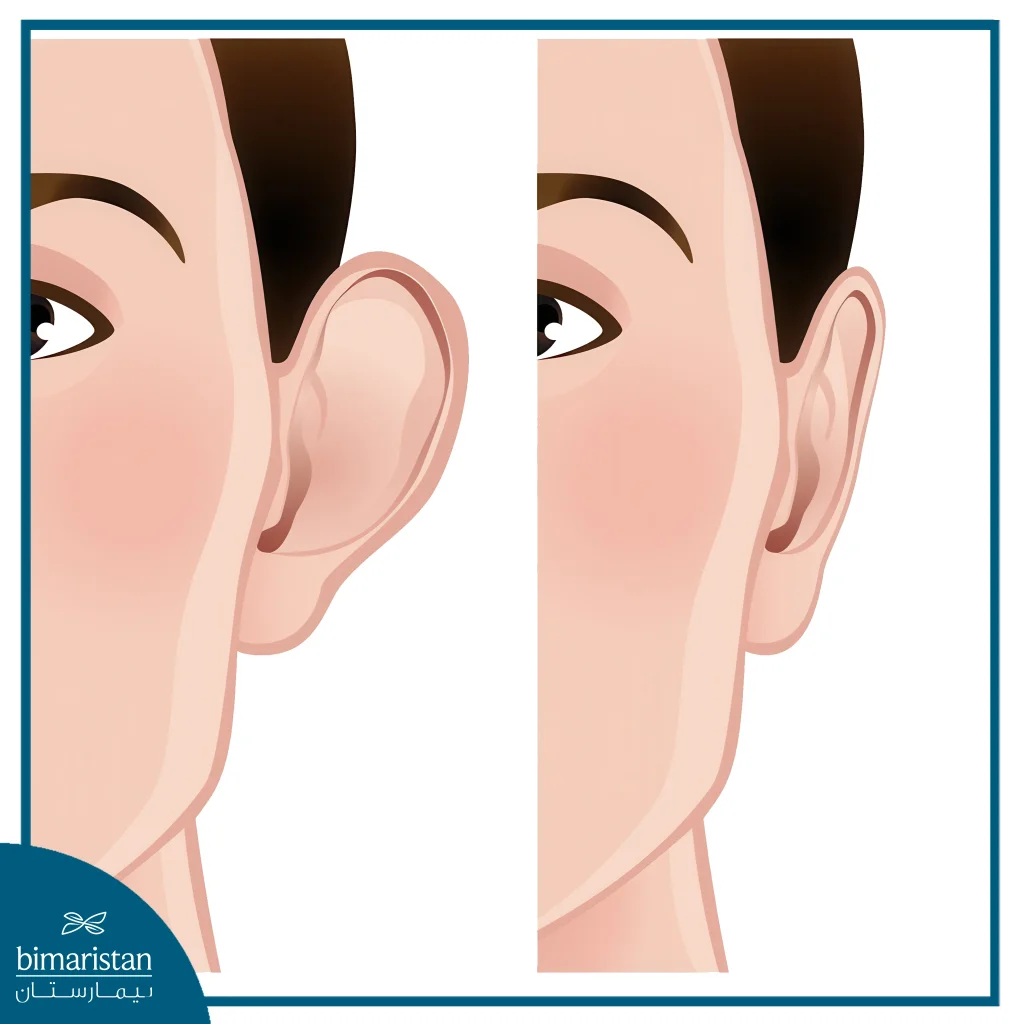 جراحة تجميل الأذن: خطوات بسيطة لمظهر رائع 2 حالة الأذن البارزة التي تحتاج لجراحة تجميل الأذن