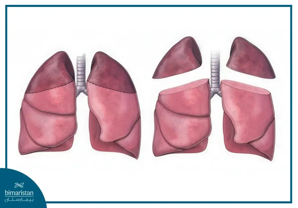 Lung Volume Reduction Surgery: Boost Breathing &Amp; Enhance Quality Of Life 5 Removing The Affected Upper Part Of The Lung