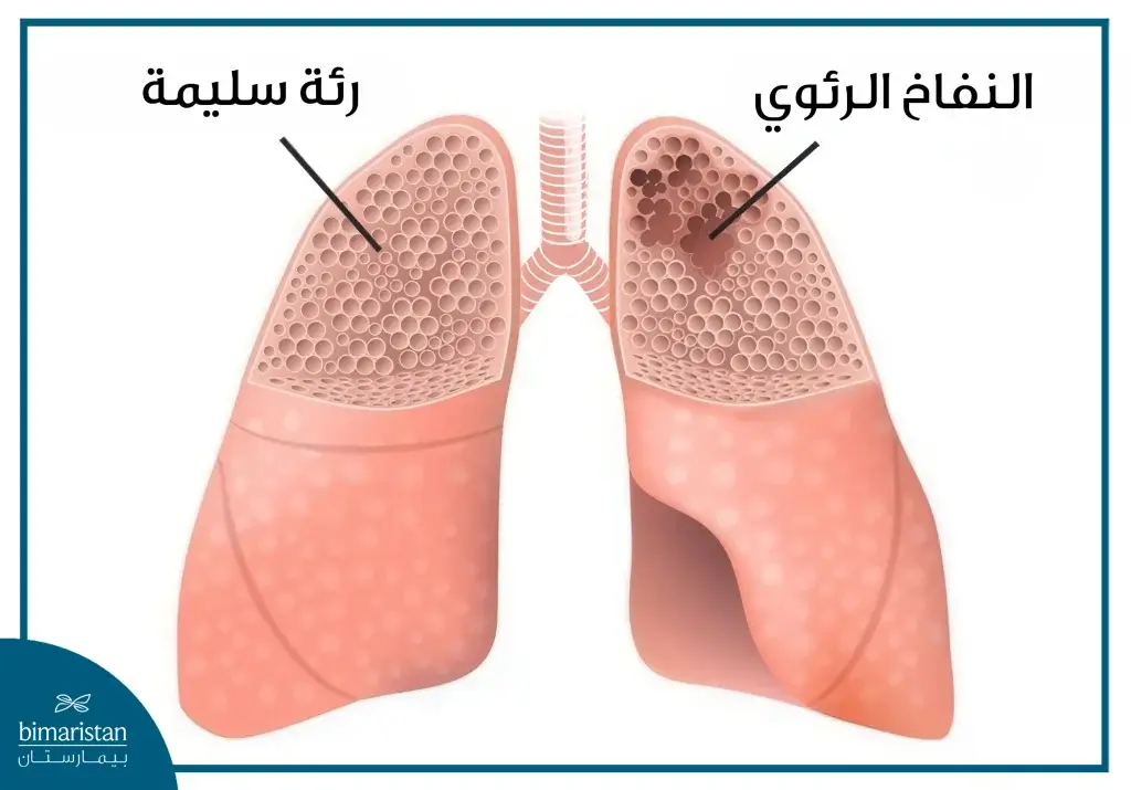 جراحة تصغير حجم الرئة: حل فعّال لتحسين التنفس والحياة 4 الفرق الرئة السليمة والرئة المصابة