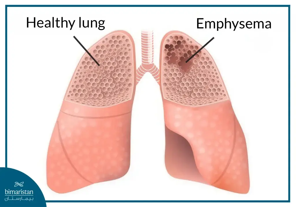 Lung Volume Reduction Surgery: Boost Breathing &Amp; Enhance Quality Of Life 3 The Difference Between A Healthy Lung And An Injured Lung