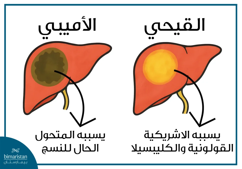 جراحة خراج الكبد: متى تُستخدم وما الخيارات المتاحة؟ 3 صورة توضح خراج الكبد الأميبي والقيحي والعامل المسبب لهما