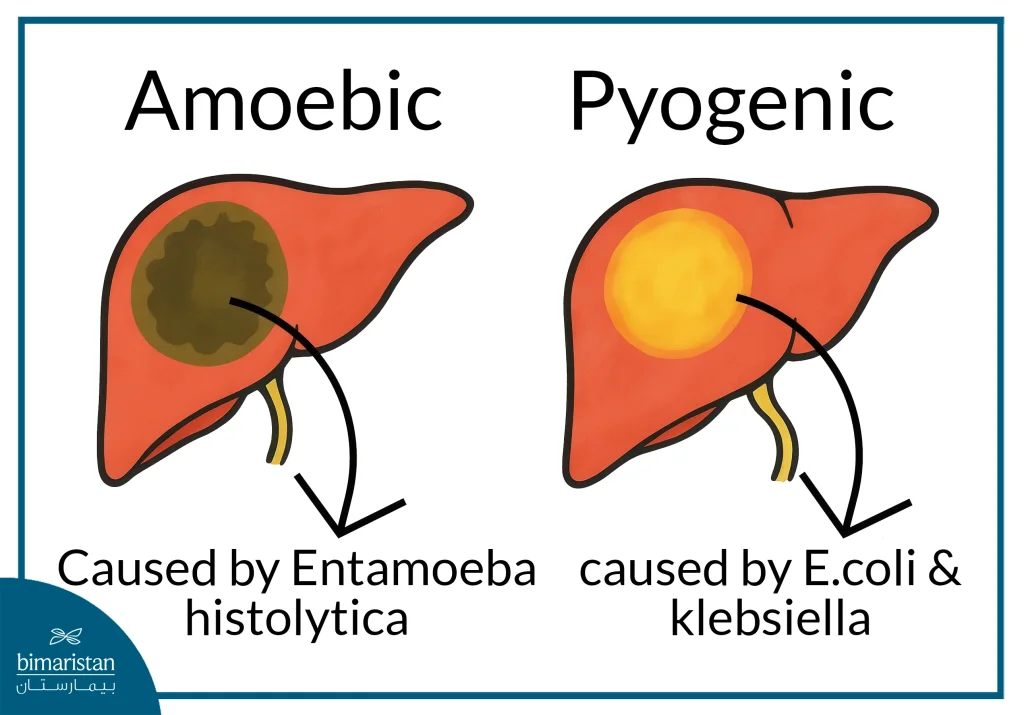 Liver Abscess Surgery: Indications And Best Treatment Options 3 Amoebic And Pyogenic Liver Abscesses And Their Causative Agent May Require Medical Treatment Or Liver Abscess Surgery In Severe Or Non-Responsive Cases.