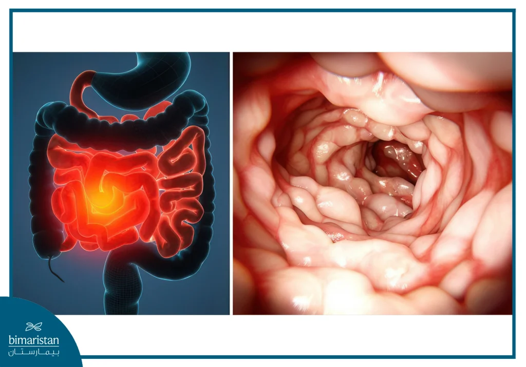 A Picture Showing What Crohn'S Disease Does To A Patient'S Body And Where It Is