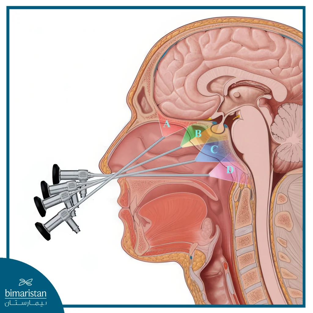 جراحة قاعدة الجمجمة: الأنواع والمخاطر وخيارات العلاج الحديثة 3 صورة توضح طرق وأماكن إدخال المنظار في جراحة قاعدة الجمجمة
