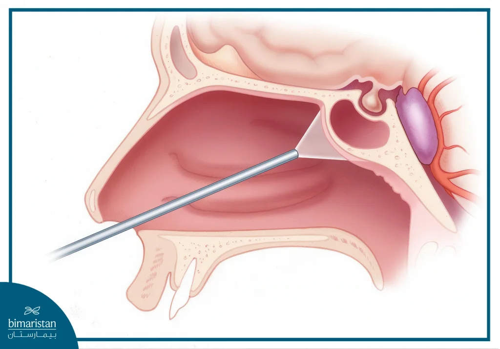 جراحة قاعدة الجمجمة: الأنواع والمخاطر وخيارات العلاج الحديثة 2 صورة توضح منظار جراحة قاعدة الجمجمة