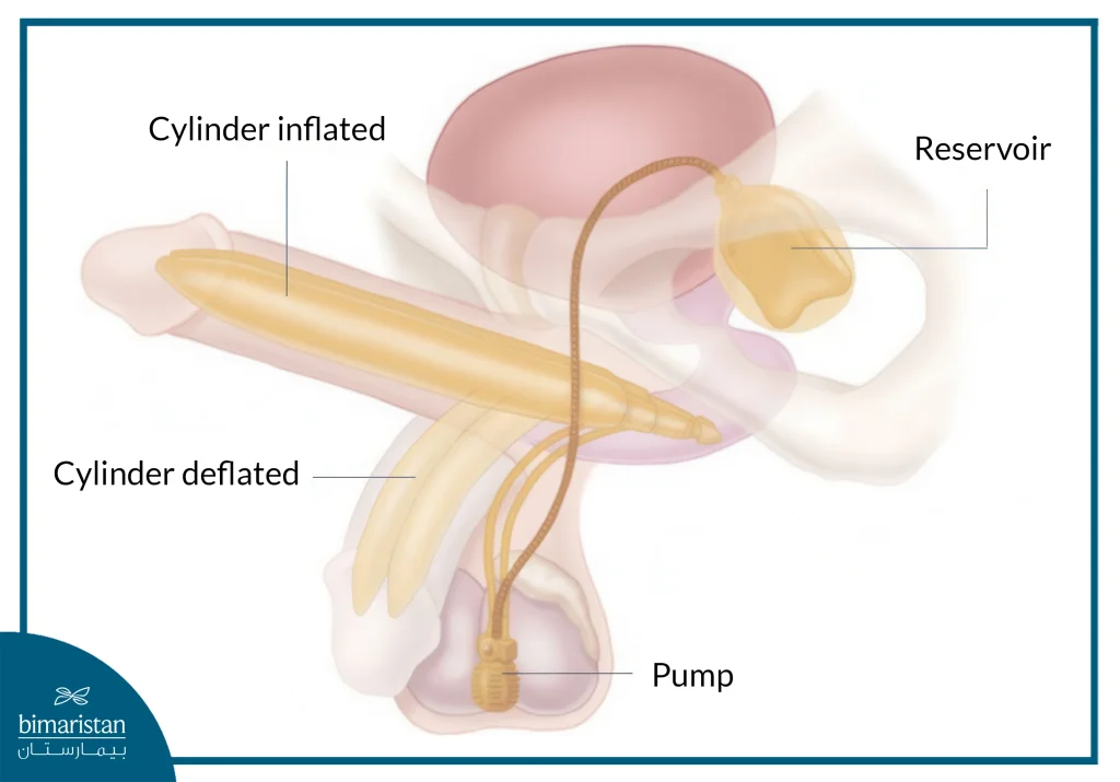 Penile Implants: The Ultimate Solution To Restore Confidence 2 Inflatable Penile Implants Model