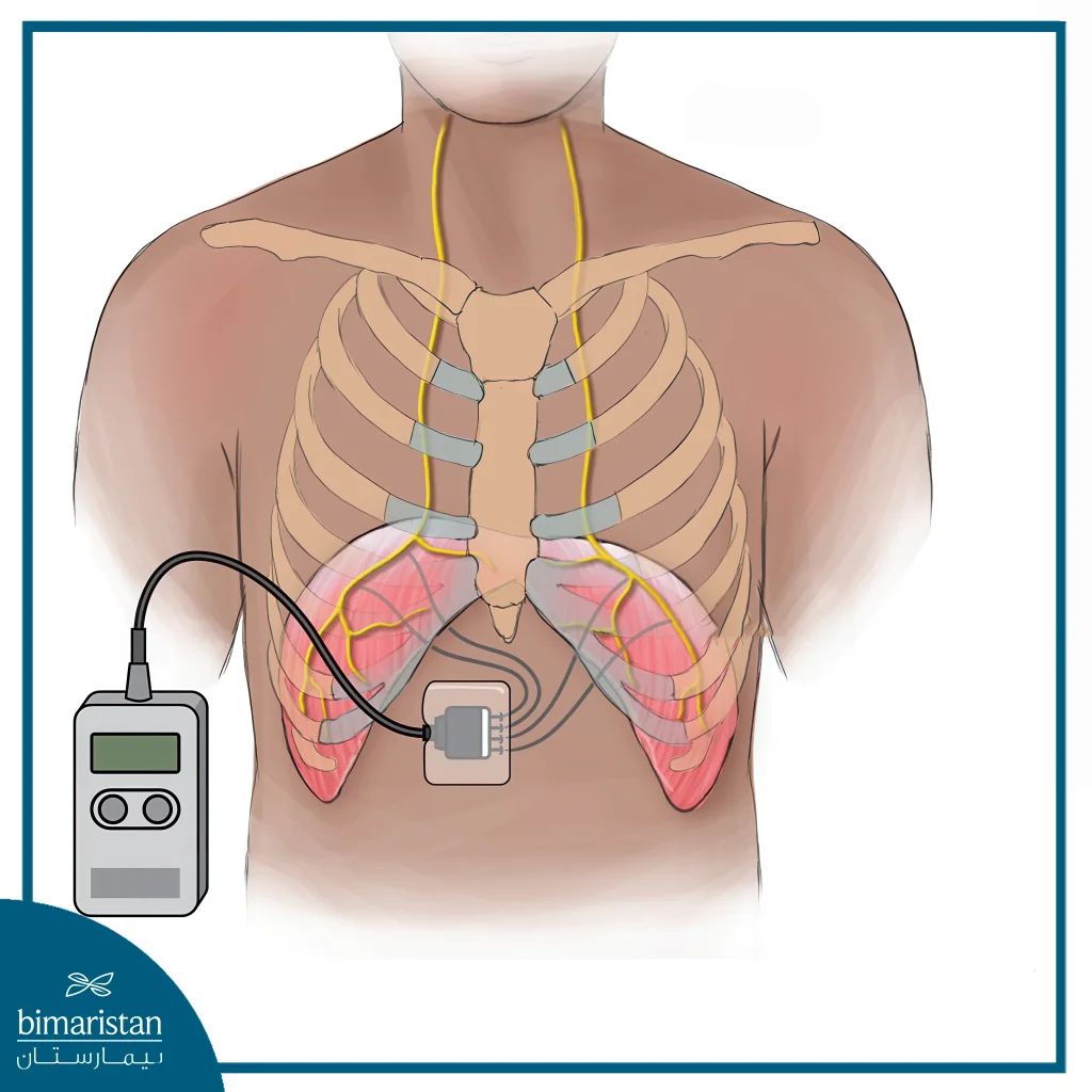 Diaphragm Pacing Surgery: A Breakthrough In Respiratory Technology 3 Diaphragm Pacing Surgery