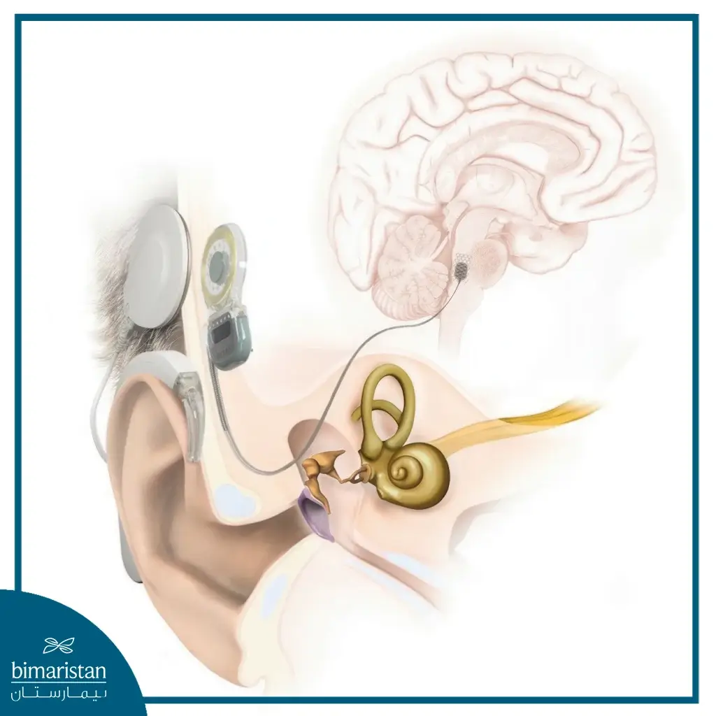 Auditory Brainstem Implant: Best Treatment Option For Deaf Patients 2 A Picture Of The Device Used In An Auditory Brainstem Implant In Turkey