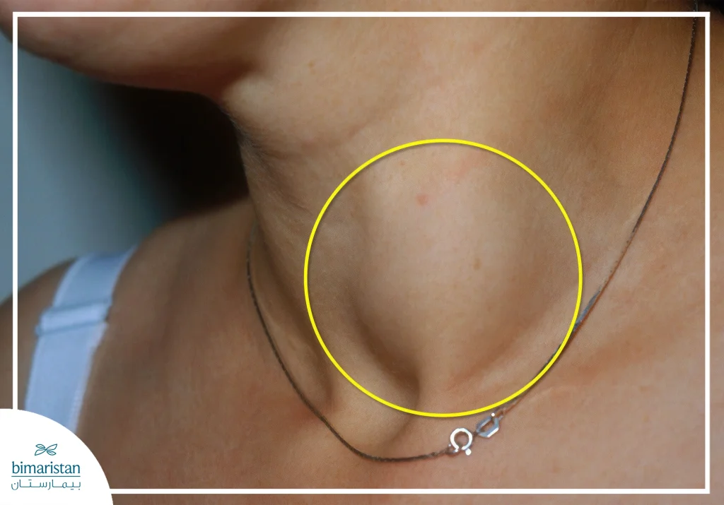 Thyroid Cancer: Signs, Symptoms, And Effective Treatment Options 4 What A Thyroid Mass Looks Like From The Outside