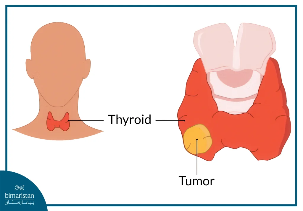 Thyroid Cancer: Signs, Symptoms, And Effective Treatment Options 3 The Position Of The Thyroid Gland In The Body