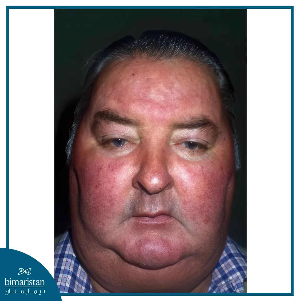 Adrenal Cancer: Your Path To Recovery 3 Abnormal Fat Distribution: A Symptom Of Adrenal Cancer