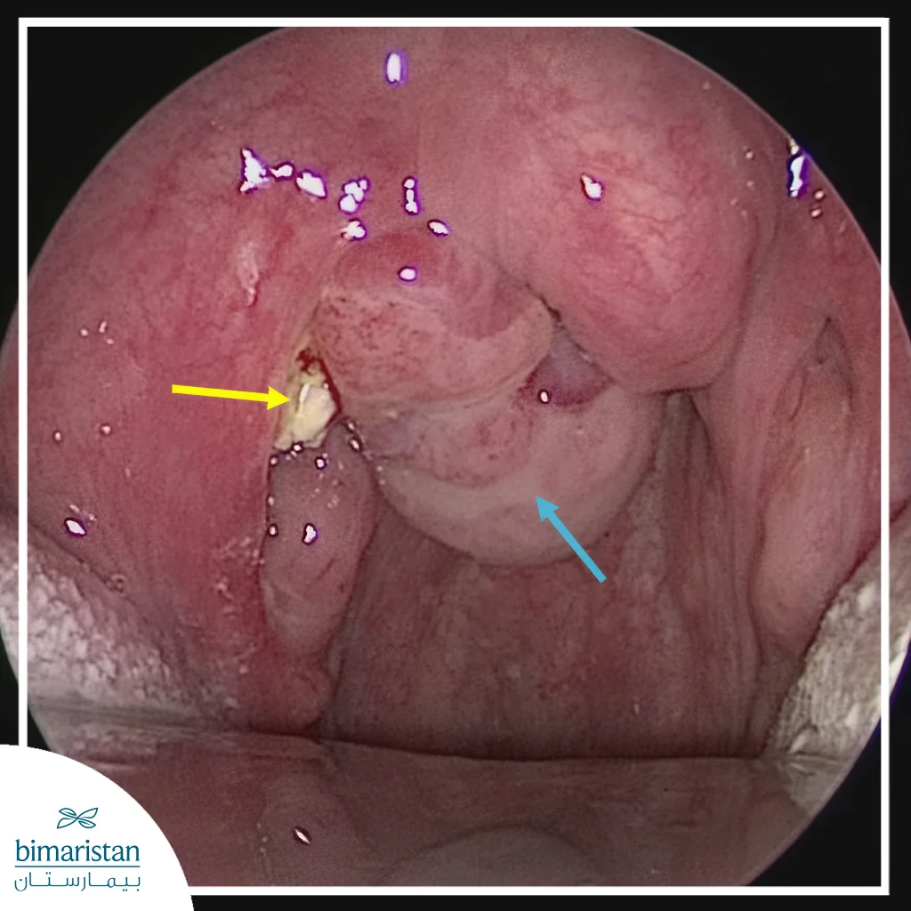 Tonsil Cancer: Malignant Symptoms And Advanced Treatment In Turkey 3 Diagnosing Tonsil Cancer With Direct Visualization When You Open Your Mouth