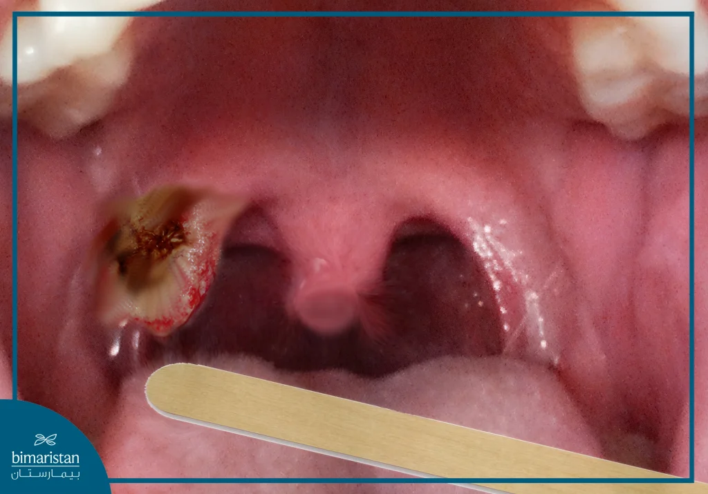 Tonsil Cancer: Malignant Symptoms And Advanced Treatment In Turkey 2 Enlarged Tonsils Indicate Tonsillar Cancer