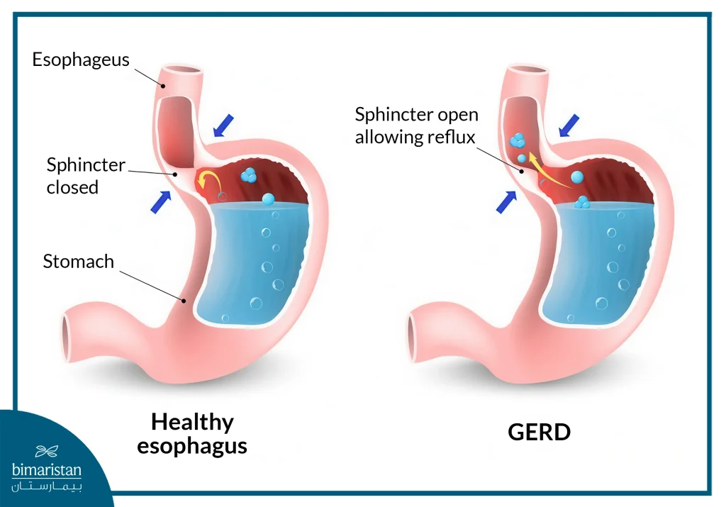 Esophagus Disease Treatment: Latest Medical &Amp; Surgical Care 3 The Most Important Steps In Esophagus Disease Treatment: Recognize The Difference Between A Normal Esophagus And Gastroesophageal Reflux Disease (Gerd).