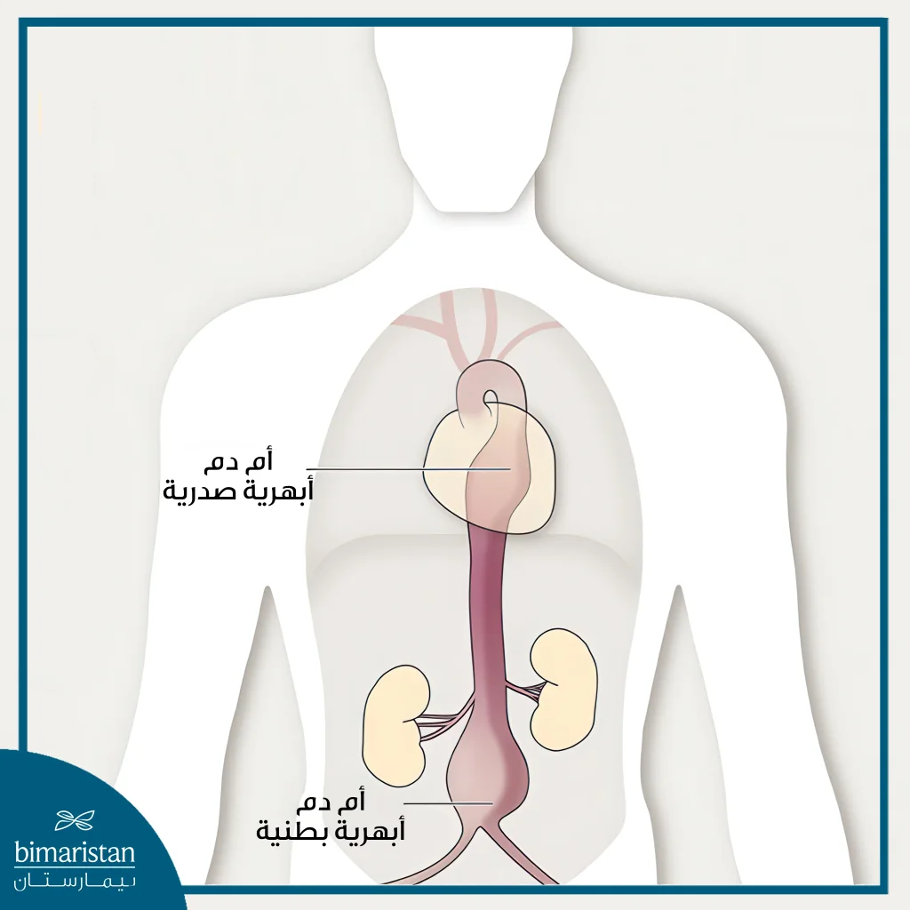 علاج أم الدم الأبهرية: متى يكون التدخل ضرورياً؟ 3 صورة توضح أم الدم الأبهرية الصدرية وأم الدم الأبهرية البطنية