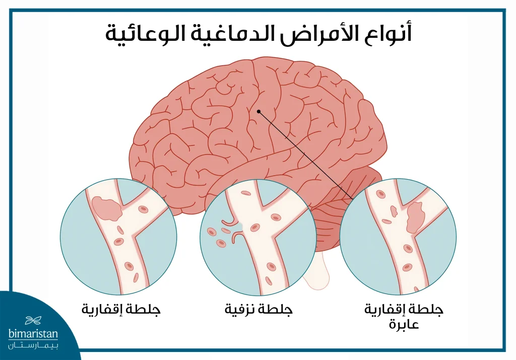 علاج الأمراض الدماغية الوعائية: أحدث التقنيات 2 صورة توضح بعض الأمراض الدماغية الوعائية