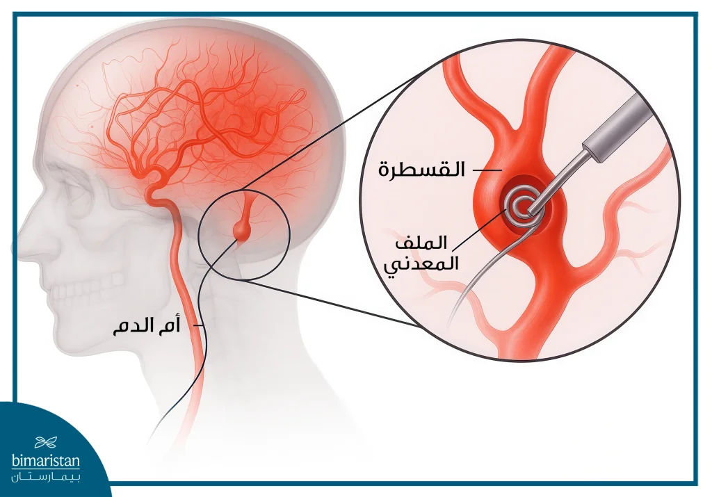علاج الانهيار الدماغي بالأشعة التداخلية: هل تنقذ الحياة؟ 4 علاج الانهيار الدماغي بالأشعة التداخلية لعلاج أم الدم