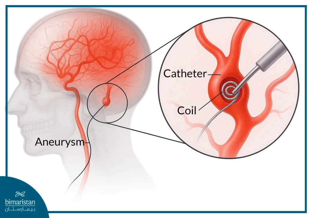 Brain Bleed Interventional Radiology Treatment
