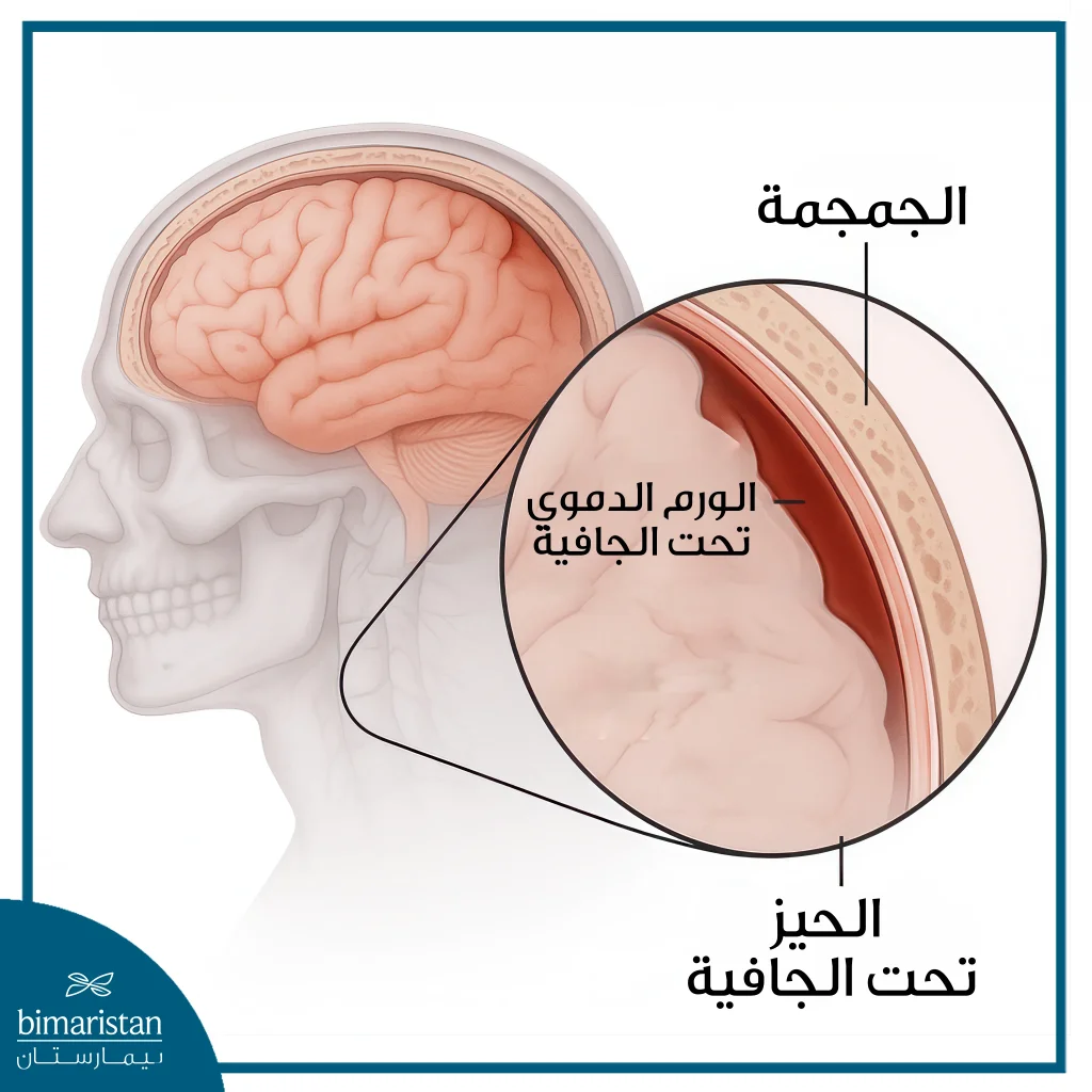 علاج الانهيار الدماغي بالأشعة التداخلية: هل تنقذ الحياة؟ 2 النزف تحت الجافية أحد استطبابات علاج الانهيار الدماغي بالأشعة التداخلية