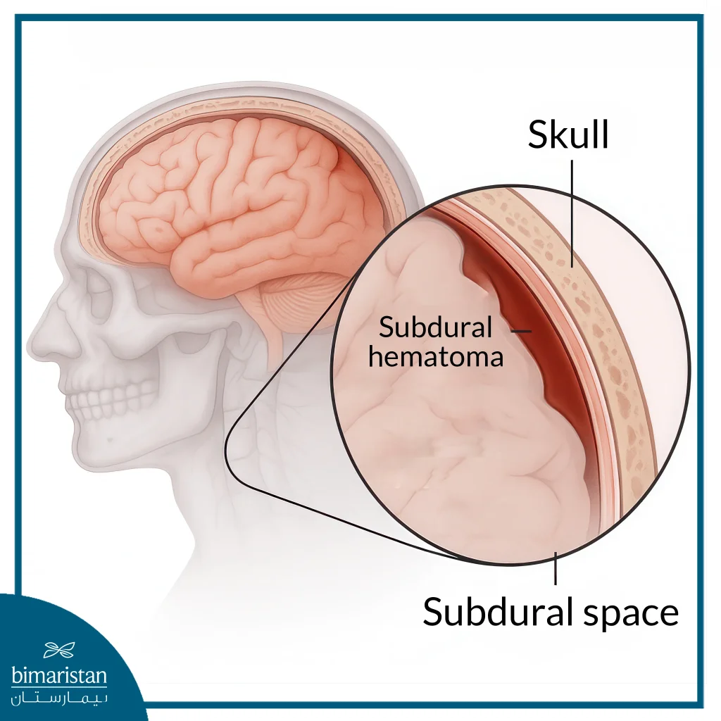 Subdural Hemorrhage Is One Of The Indications For Brain Bleed Interventional Radiology Treatment, Offering A Less Invasive Approach To Manage Bleeding.
