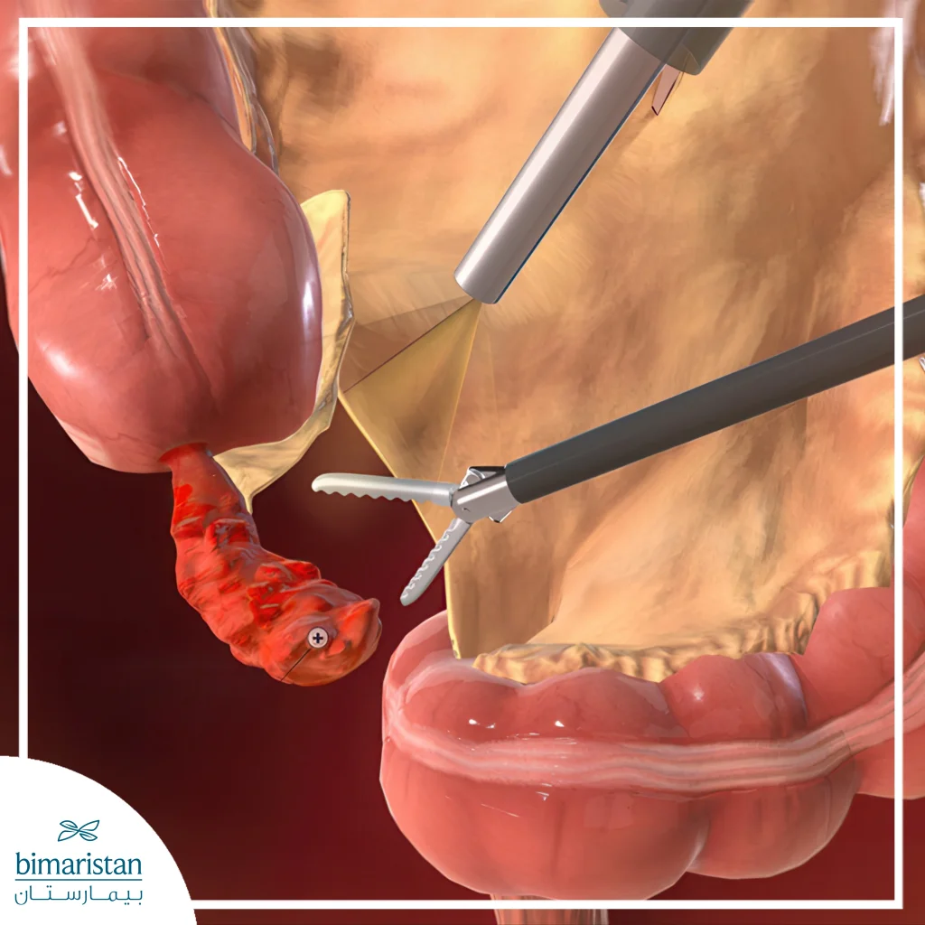 Pediatric Appendicitis Treatment: A Comprehensive Guide For Parents 3 Laparoscopic Appendectomy Is A Common Form Of Pediatric Appendicitis Treatment.
